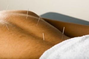 acupuntura medica
